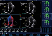  PROVIVO  STRESS ECHO - próba dobutaminowa