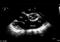  PROVIVO ECHOKARDIOGRAFIA PRZEZPRZEŁYKOWA TEE